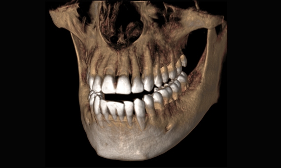 3D-Röntgenaufnahme eines Schädels ‒ Zahnarztpraxis Mark André Tesmer